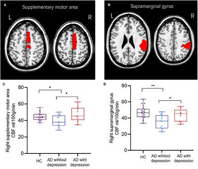 Altered Cerebral Blood Flow in Alzheimer's Disease With Depression